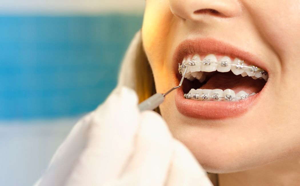 Aparaty ortodontyczne - jak działają i kiedy warto je założyć?
